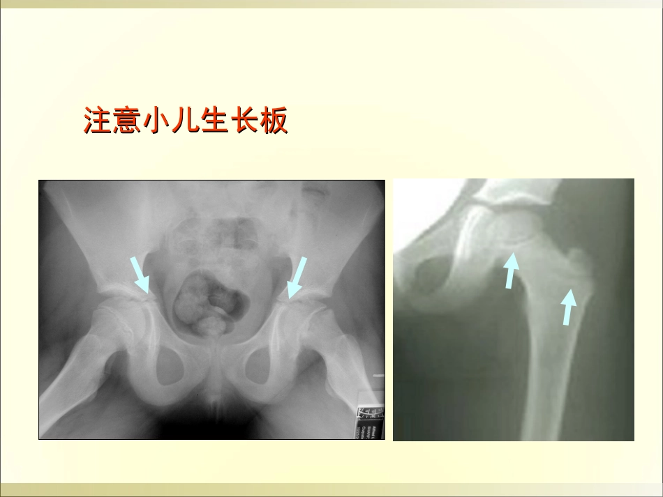 外影像与诊断学：骨科读片基础_第15页