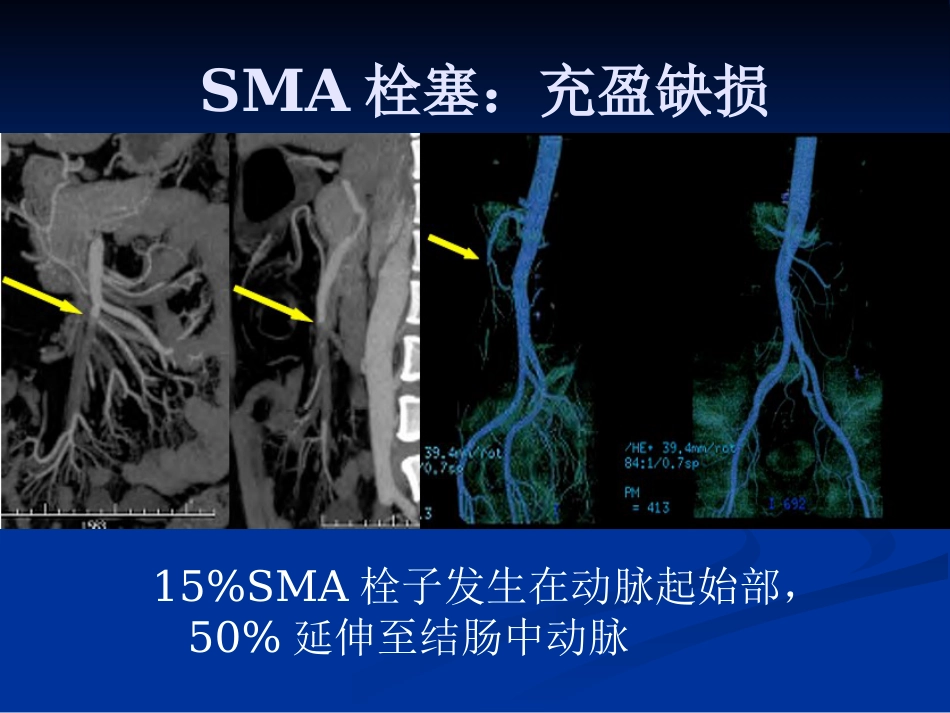 肠系膜血管病变的影像诊断及介入治疗PPT课件_第15页