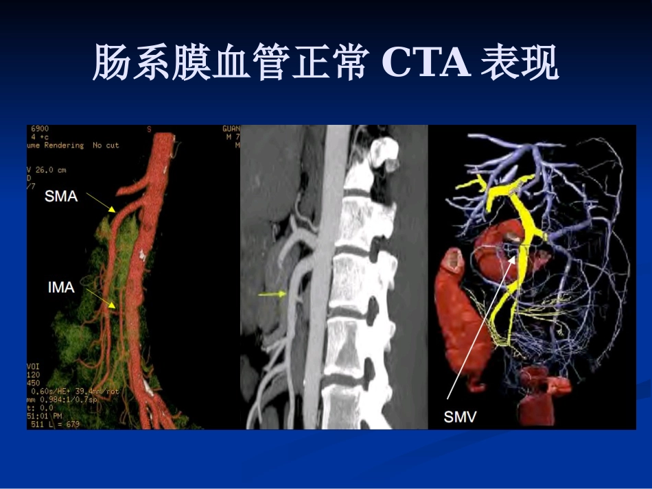 肠系膜血管病变的影像诊断及介入治疗PPT课件_第8页