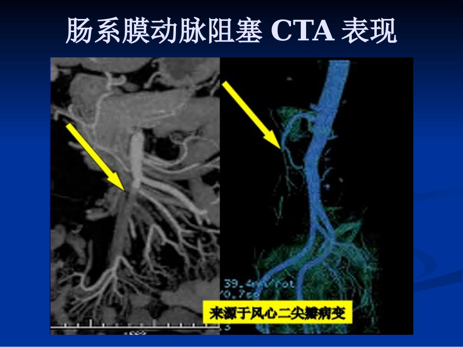 肠系膜血管病变的影像诊断及介入治疗PPT课件_第9页