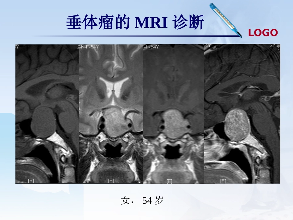 鞍区肿瘤影像诊断_第13页