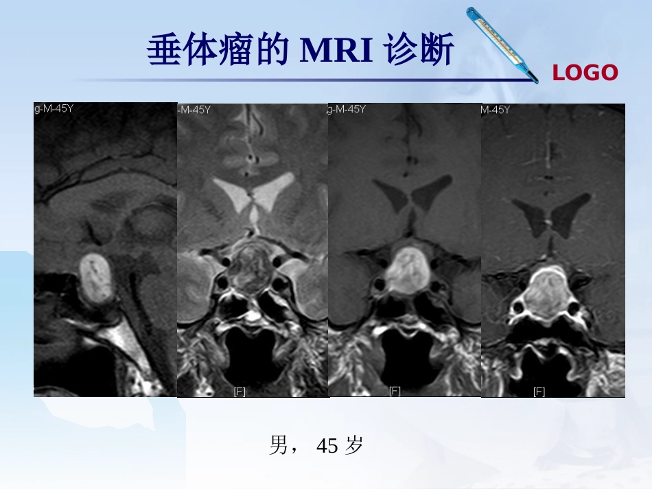 鞍区肿瘤影像诊断_第14页
