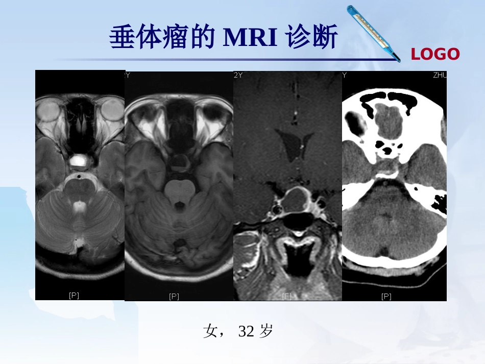 鞍区肿瘤影像诊断_第15页