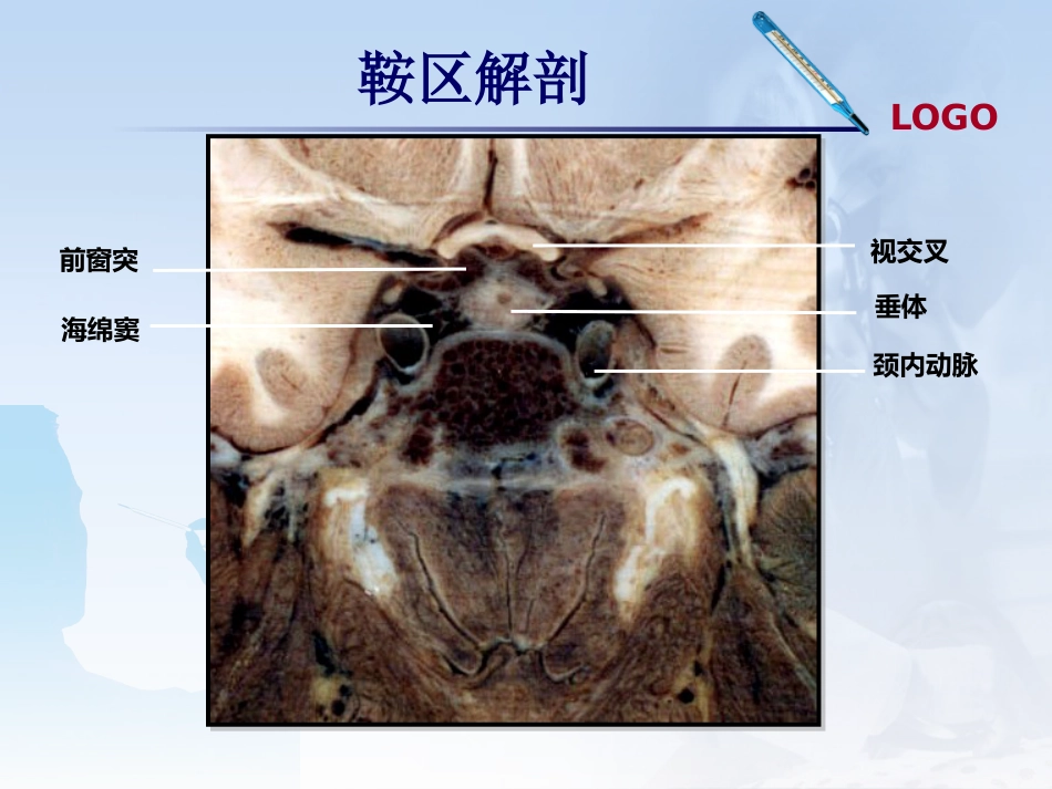 鞍区肿瘤影像诊断_第4页