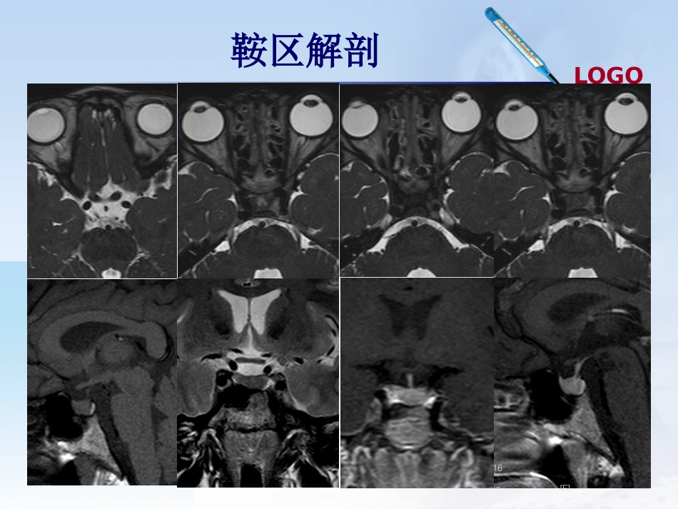 鞍区肿瘤影像诊断_第6页