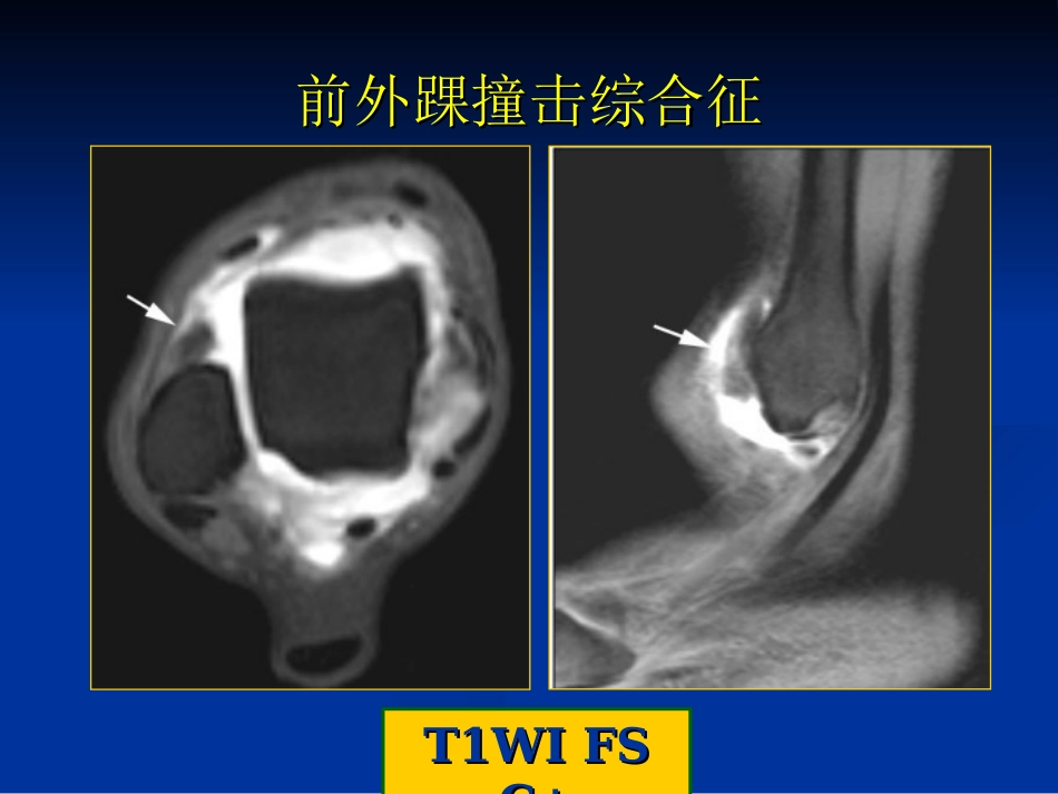 外影像与诊断学：踝关节撞击综合征影像学_第10页