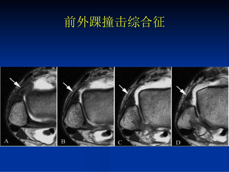 外影像与诊断学：踝关节撞击综合征影像学_第11页