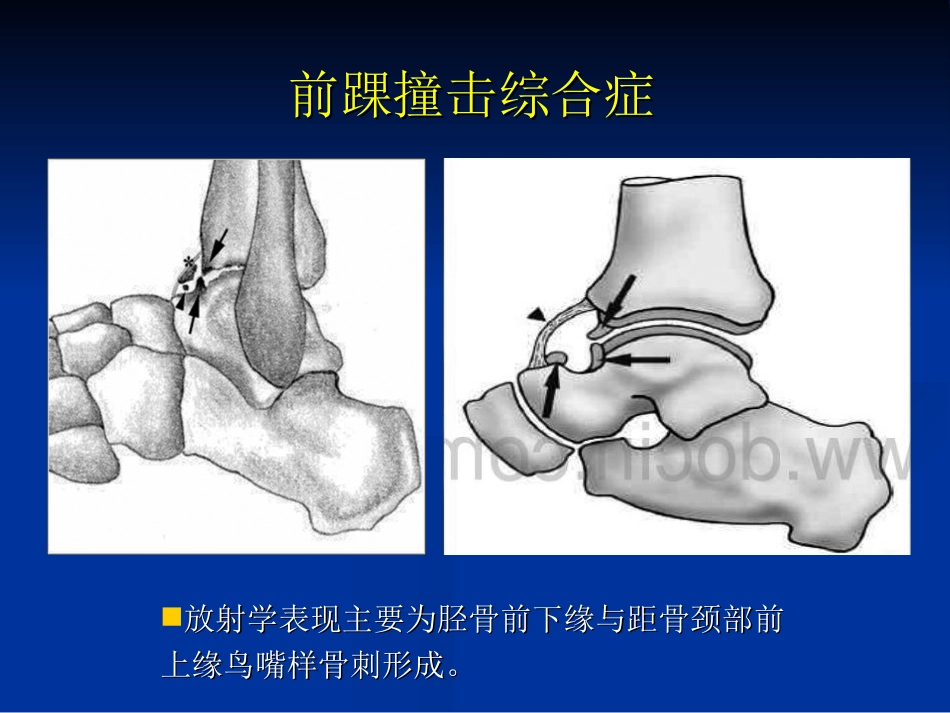 外影像与诊断学：踝关节撞击综合征影像学_第14页