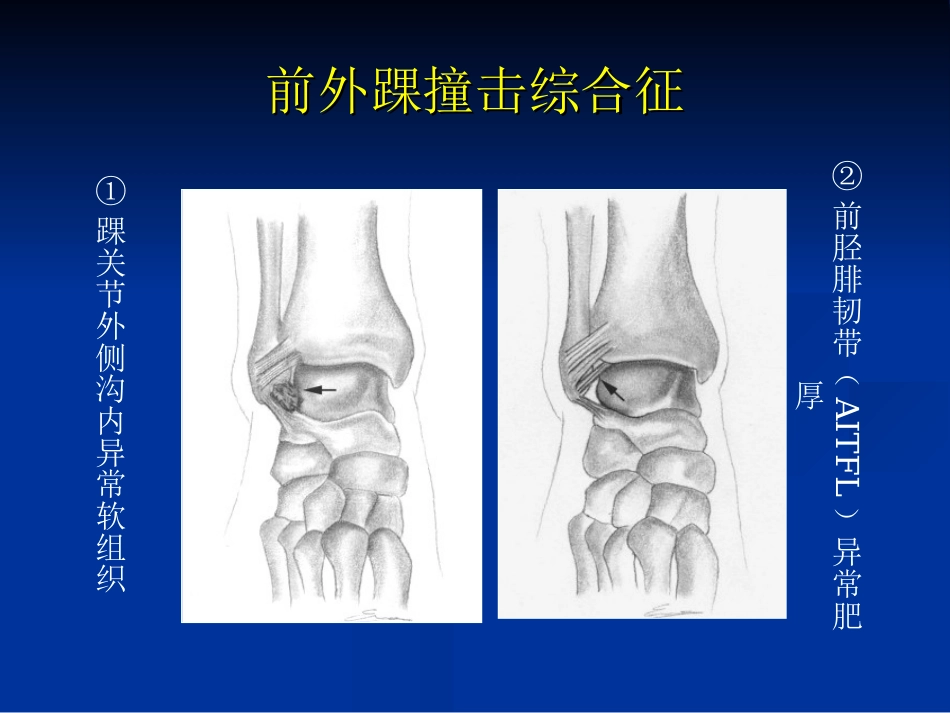 外影像与诊断学：踝关节撞击综合征影像学_第9页