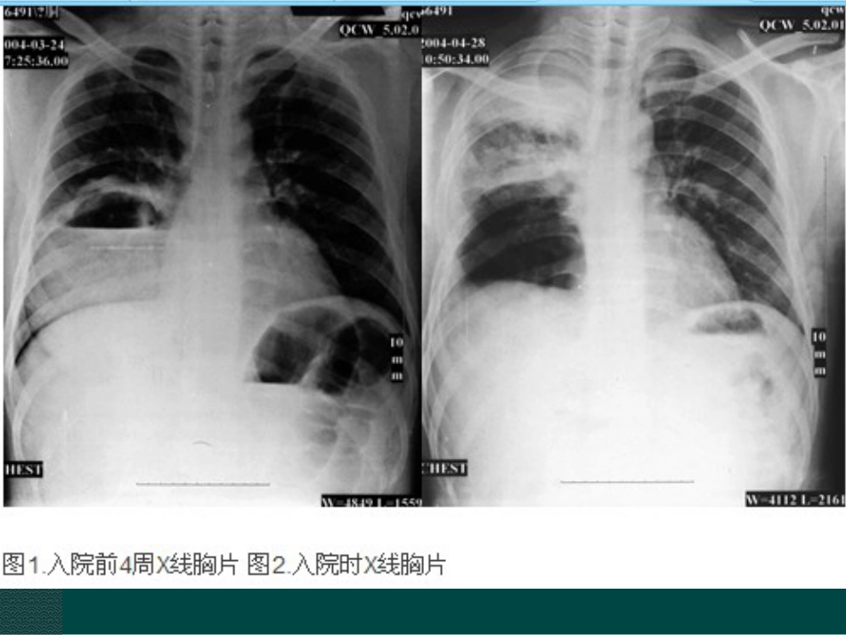 ANCA相关小血管炎在肺部影像学表现_第14页