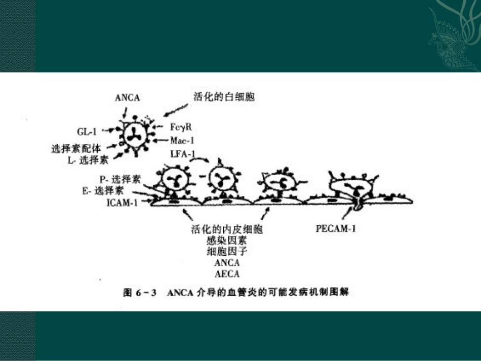 ANCA相关小血管炎在肺部影像学表现_第8页