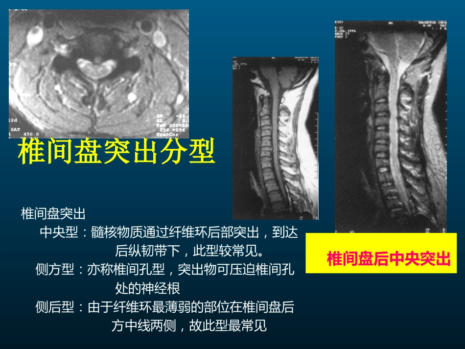 外影像与诊断学：颈椎病的MRI诊断_第15页