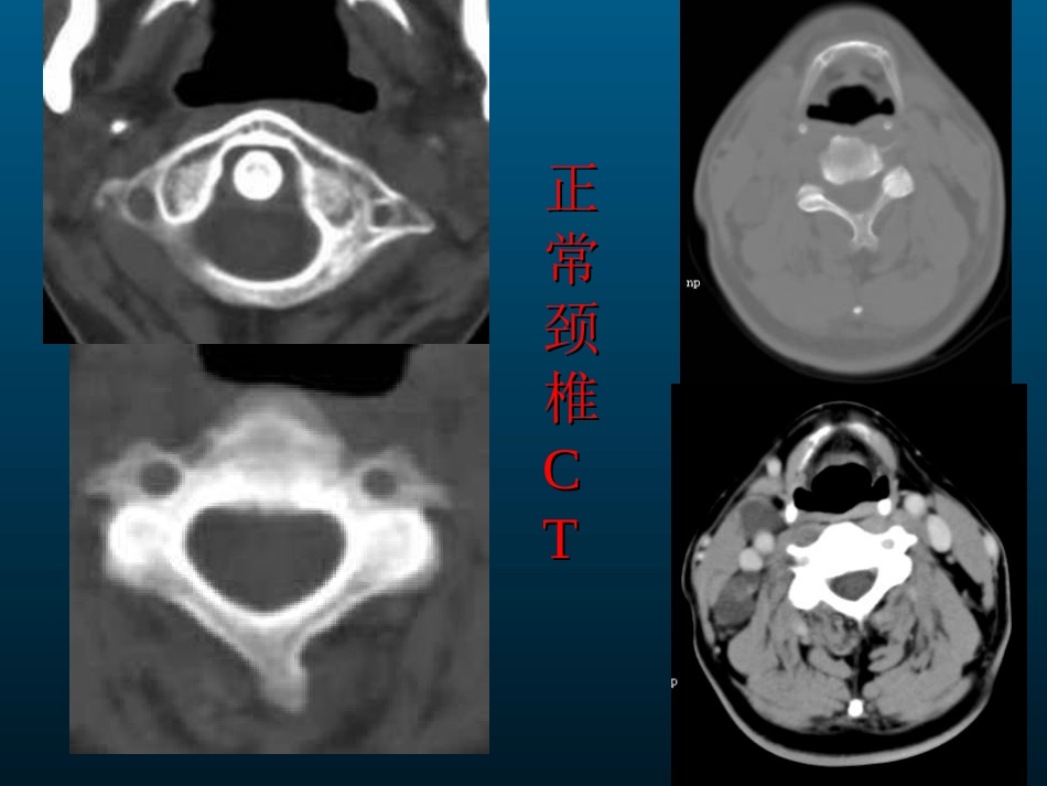 外影像与诊断学：颈椎病的MRI诊断_第7页