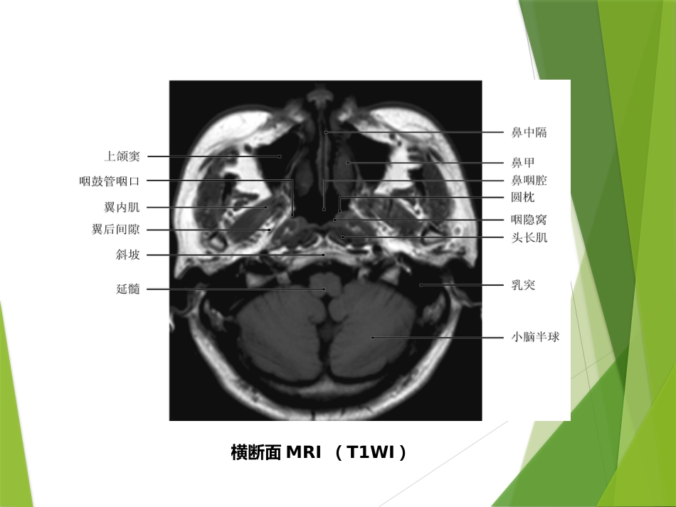 鼻咽及颅内肿瘤影像_第10页