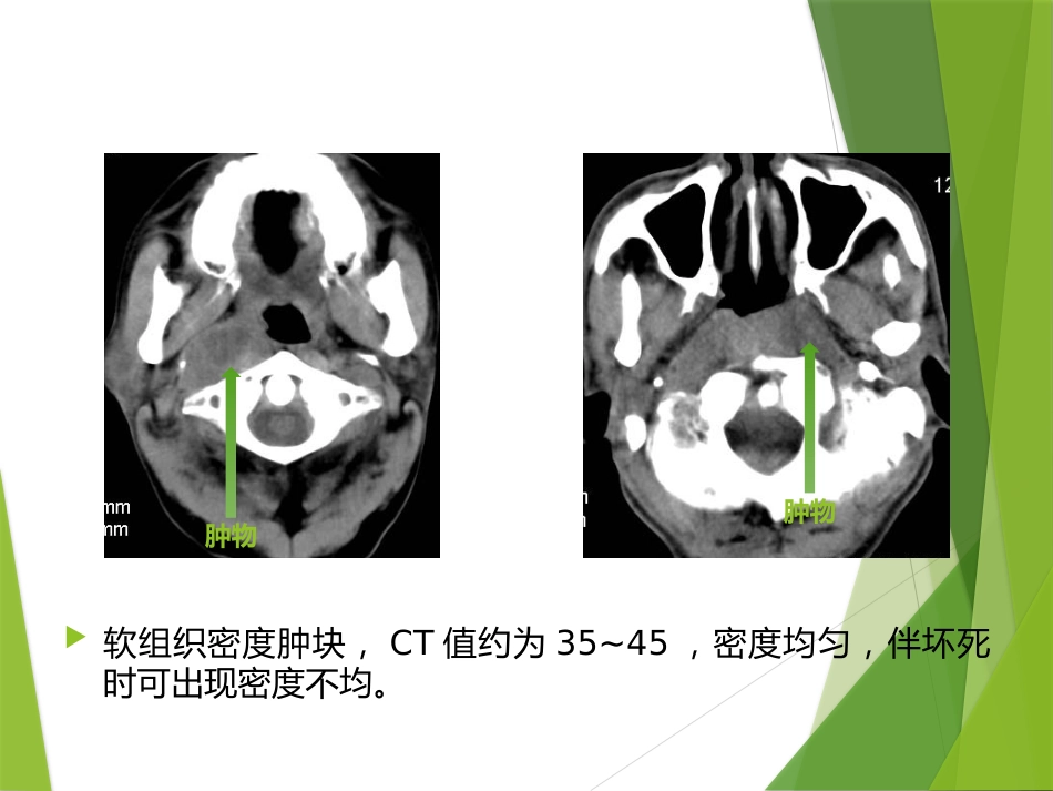 鼻咽及颅内肿瘤影像_第14页
