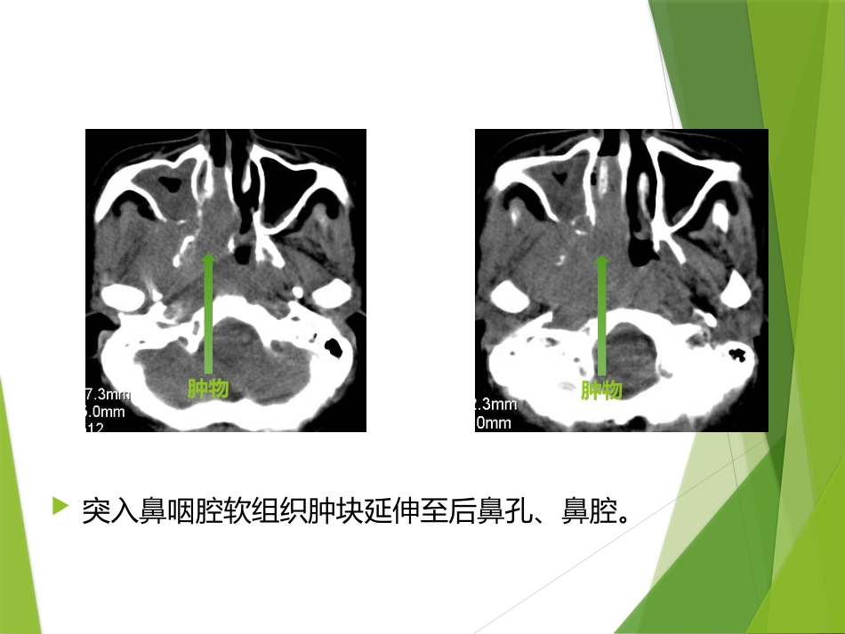 鼻咽及颅内肿瘤影像_第15页