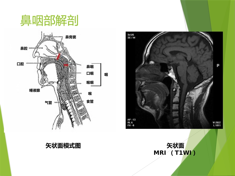 鼻咽及颅内肿瘤影像_第7页
