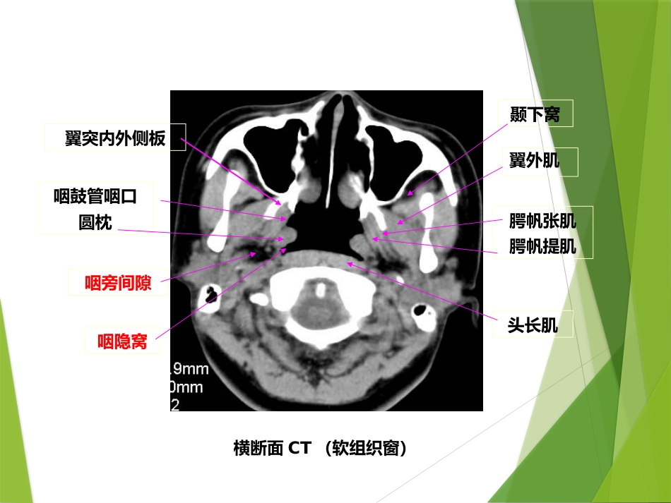 鼻咽及颅内肿瘤影像_第8页
