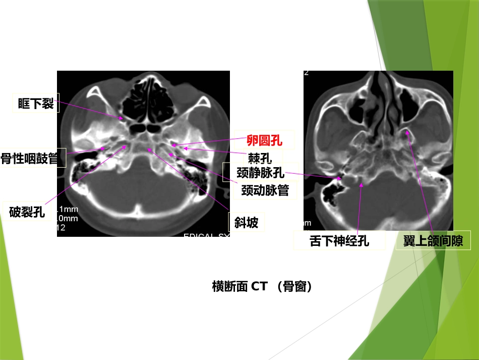 鼻咽及颅内肿瘤影像_第9页