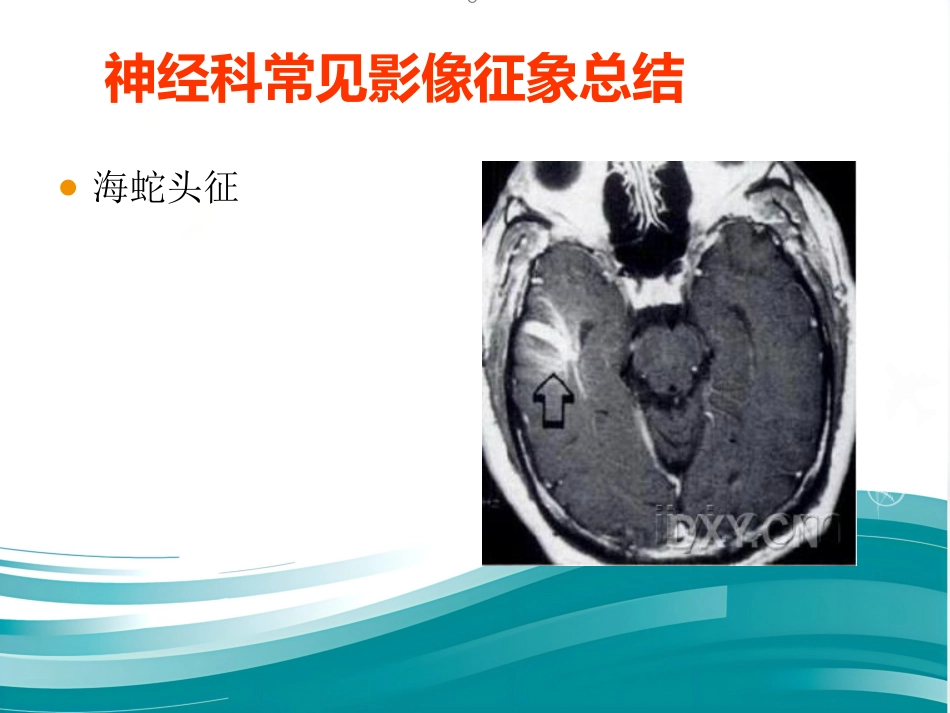 常见神经科影像资料_第10页