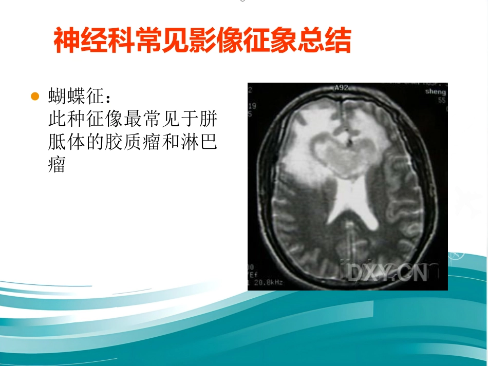 常见神经科影像资料_第11页