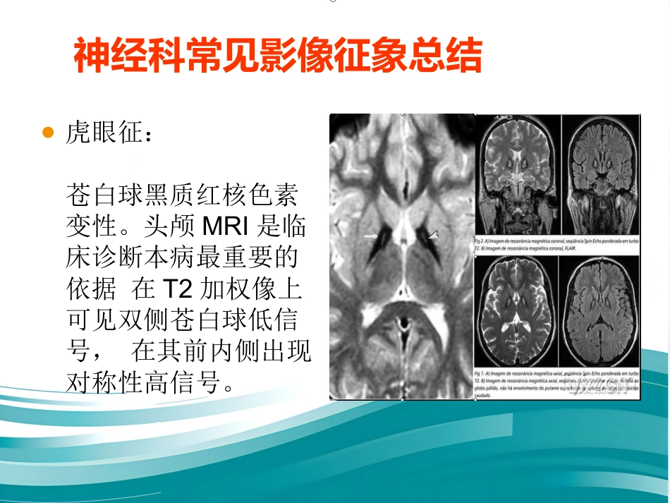 常见神经科影像资料_第12页