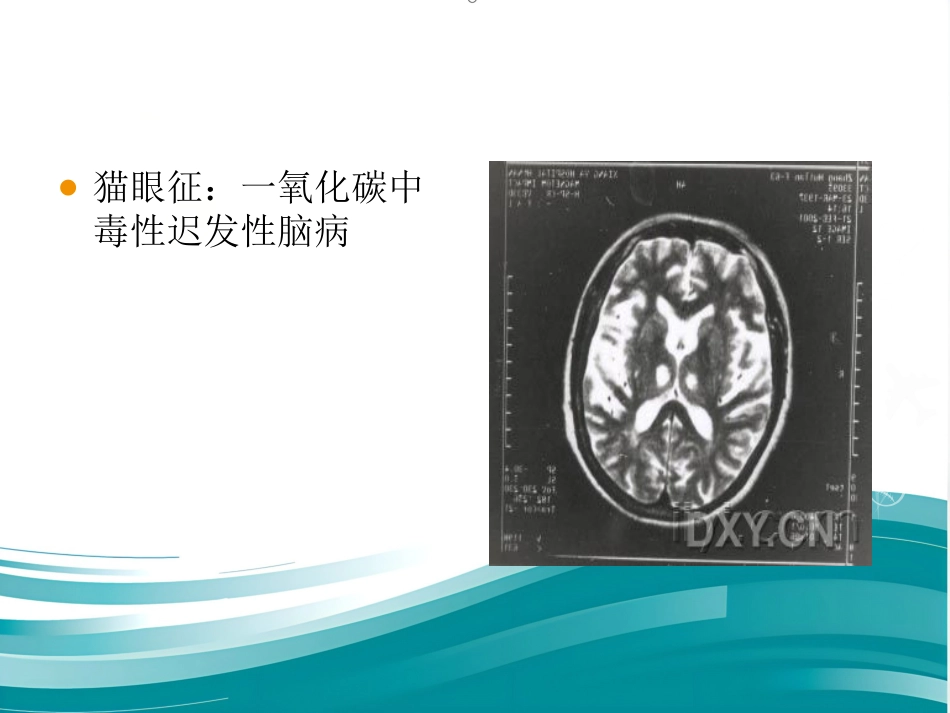 常见神经科影像资料_第13页