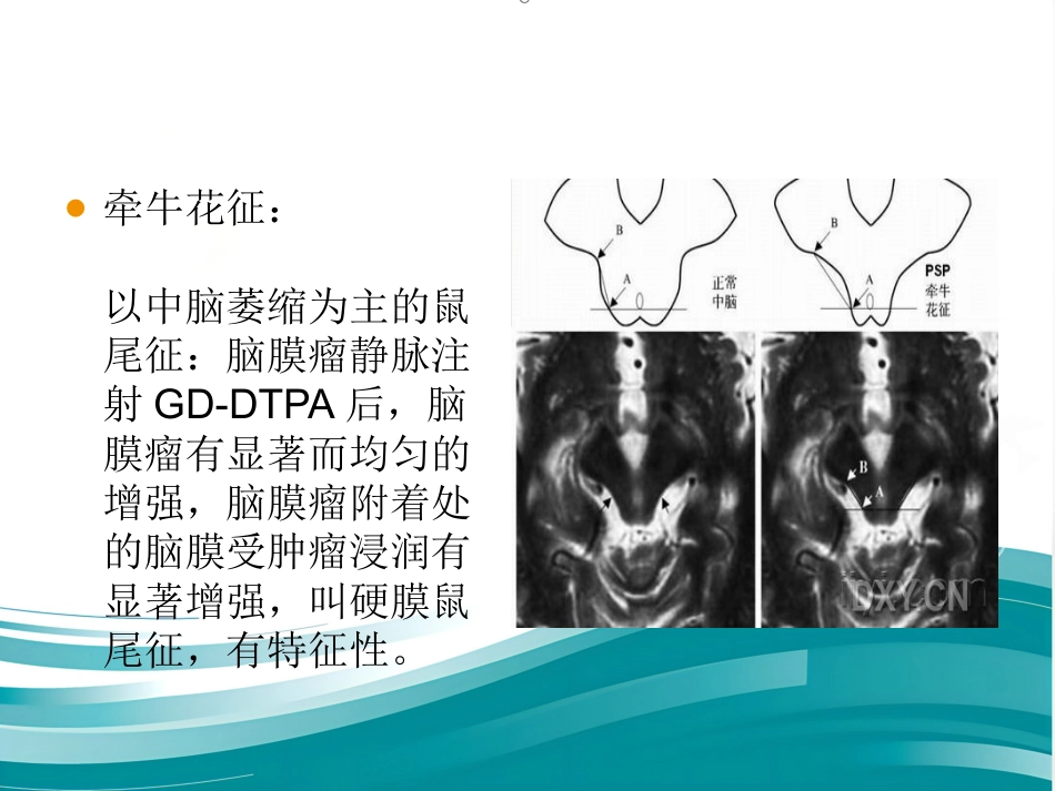 常见神经科影像资料_第14页