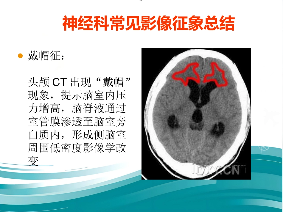 常见神经科影像资料_第2页
