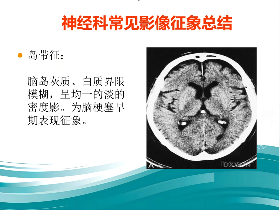 常见神经科影像资料_第3页