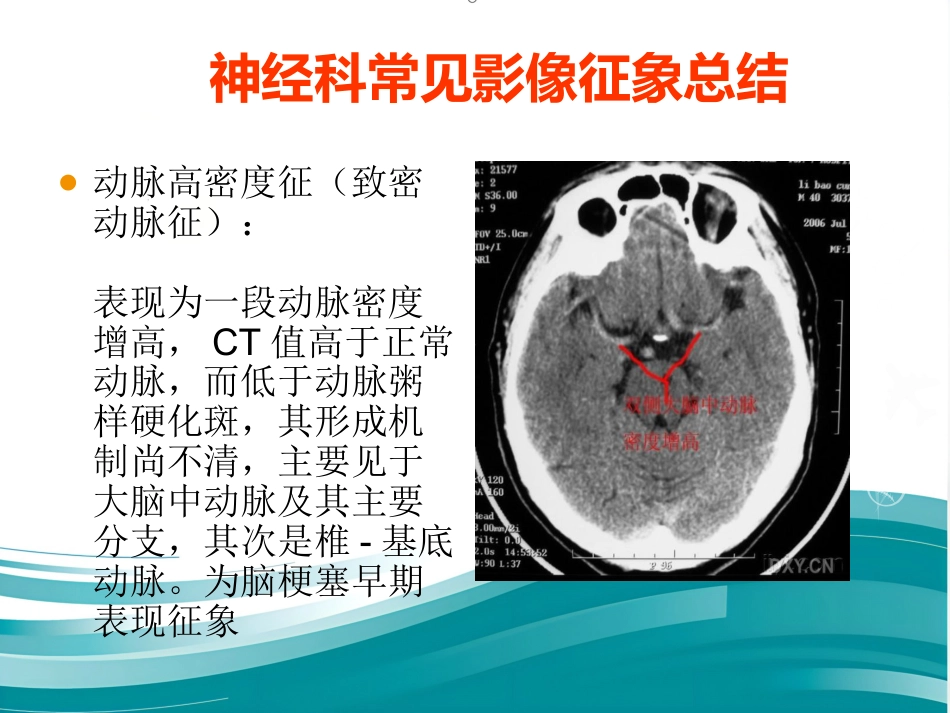 常见神经科影像资料_第4页
