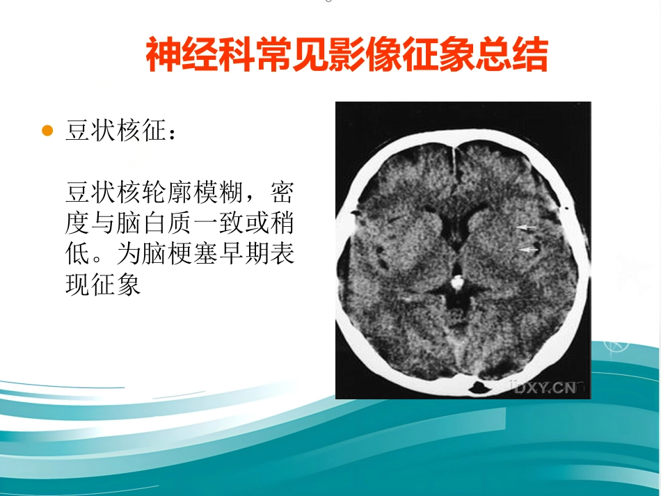 常见神经科影像资料_第6页