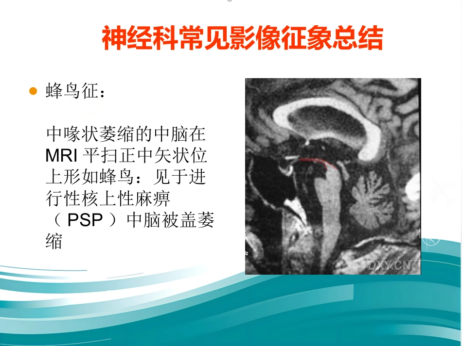 常见神经科影像资料_第7页