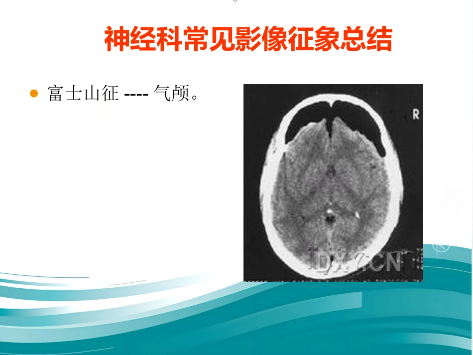 常见神经科影像资料_第8页