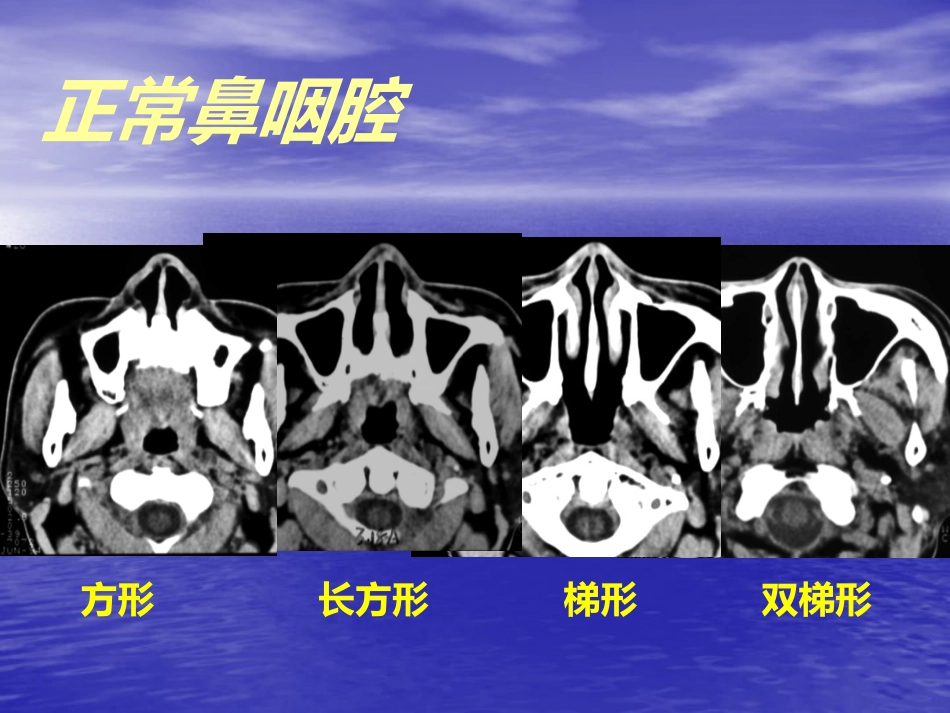 鼻咽癌的影像诊断_第6页
