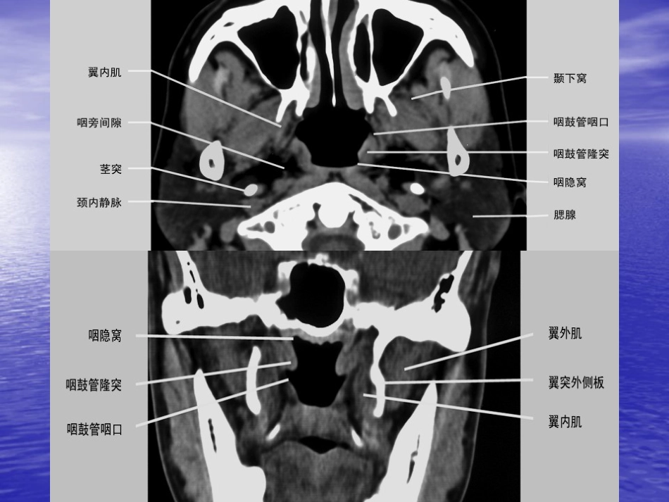 鼻咽癌的影像诊断_第7页