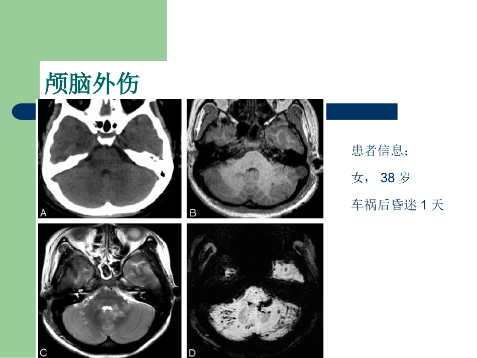 磁敏感加权成像在中枢神经系统的应用_第11页