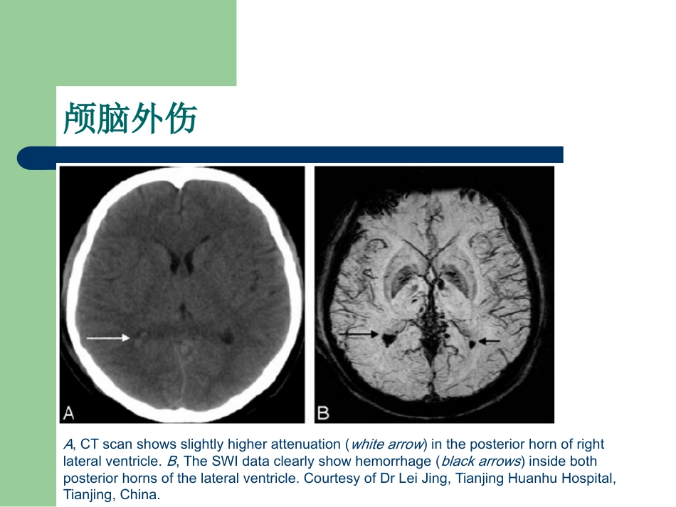 磁敏感加权成像在中枢神经系统的应用_第12页