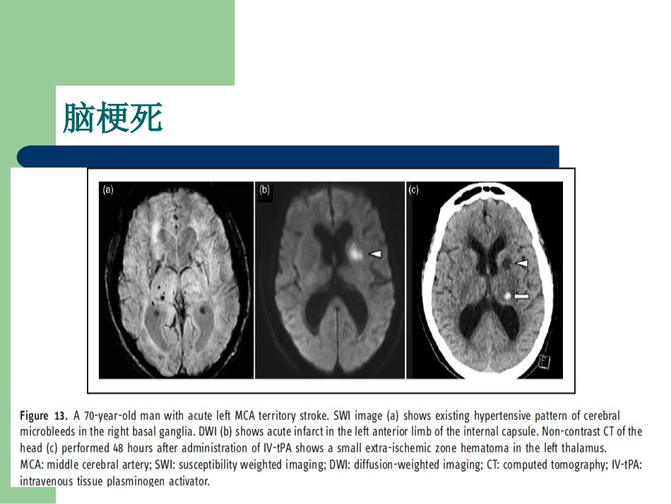 磁敏感加权成像在中枢神经系统的应用_第14页