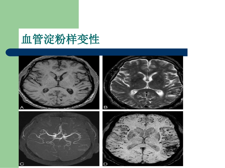 磁敏感加权成像在中枢神经系统的应用_第15页