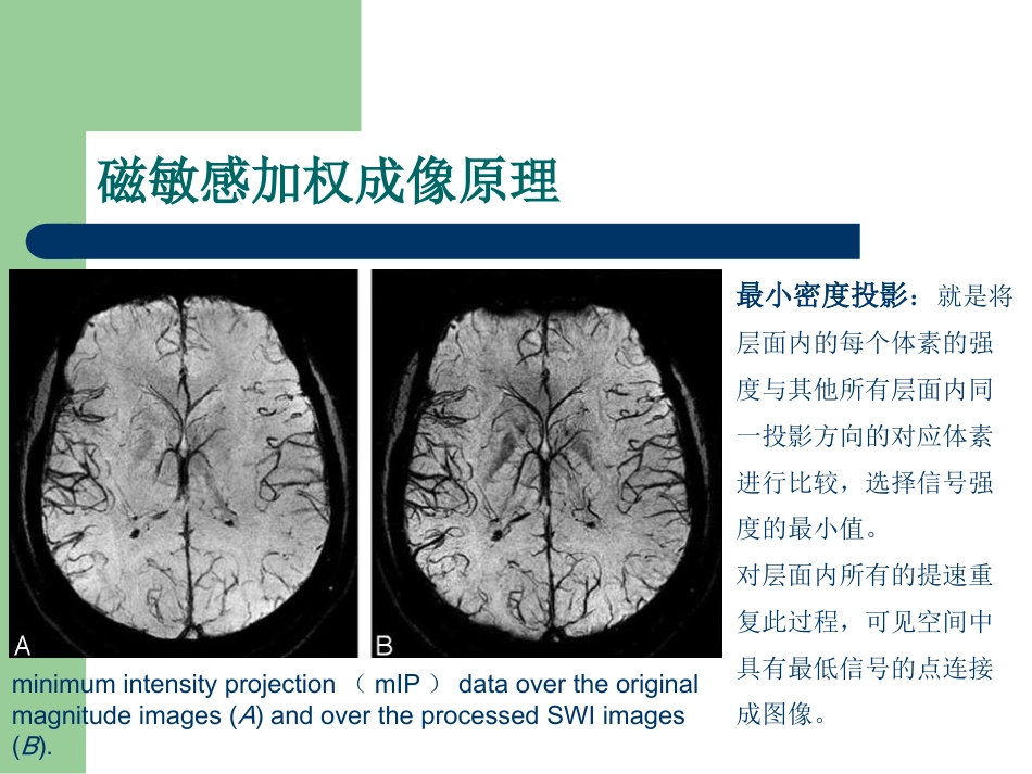 磁敏感加权成像在中枢神经系统的应用_第4页