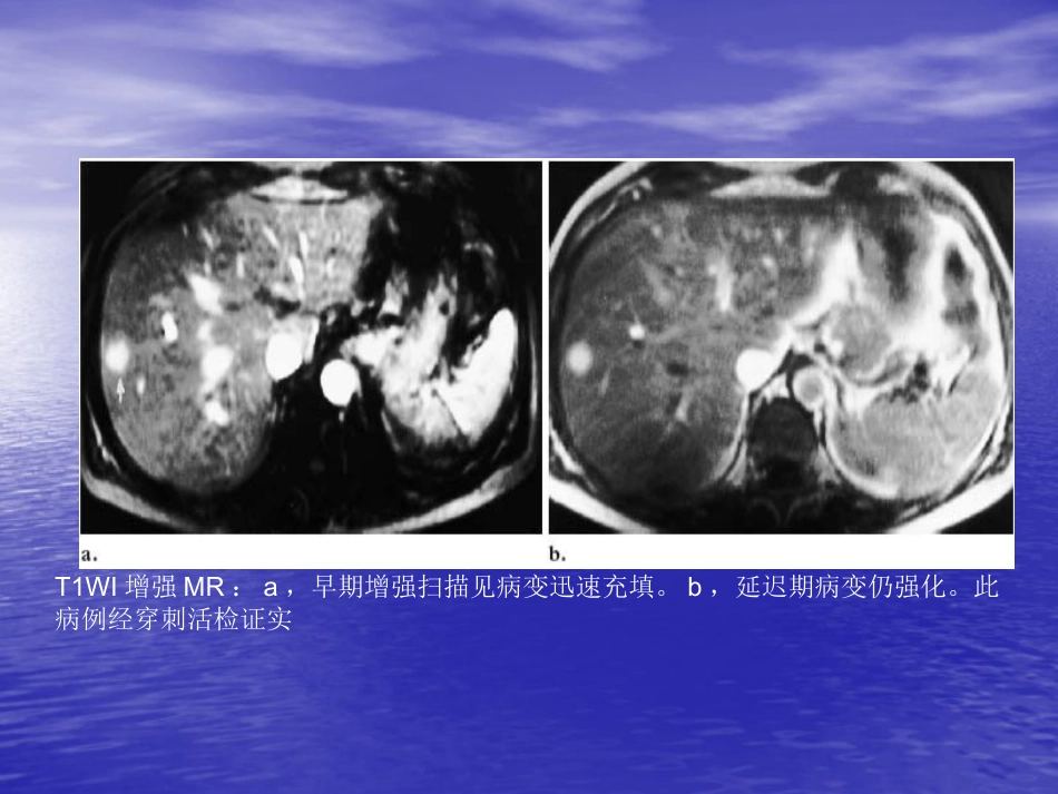不典型肝血管瘤的影像学表现_第3页