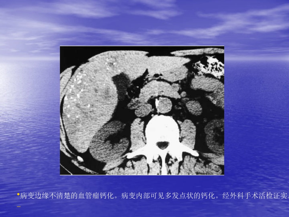 不典型肝血管瘤的影像学表现_第5页