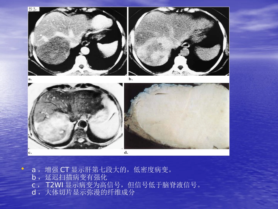 不典型肝血管瘤的影像学表现_第7页