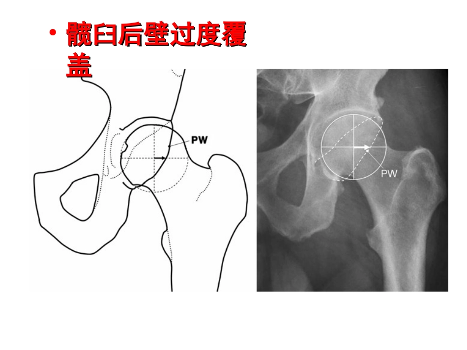 外影像与诊断学：成人髋关节影像学_第11页