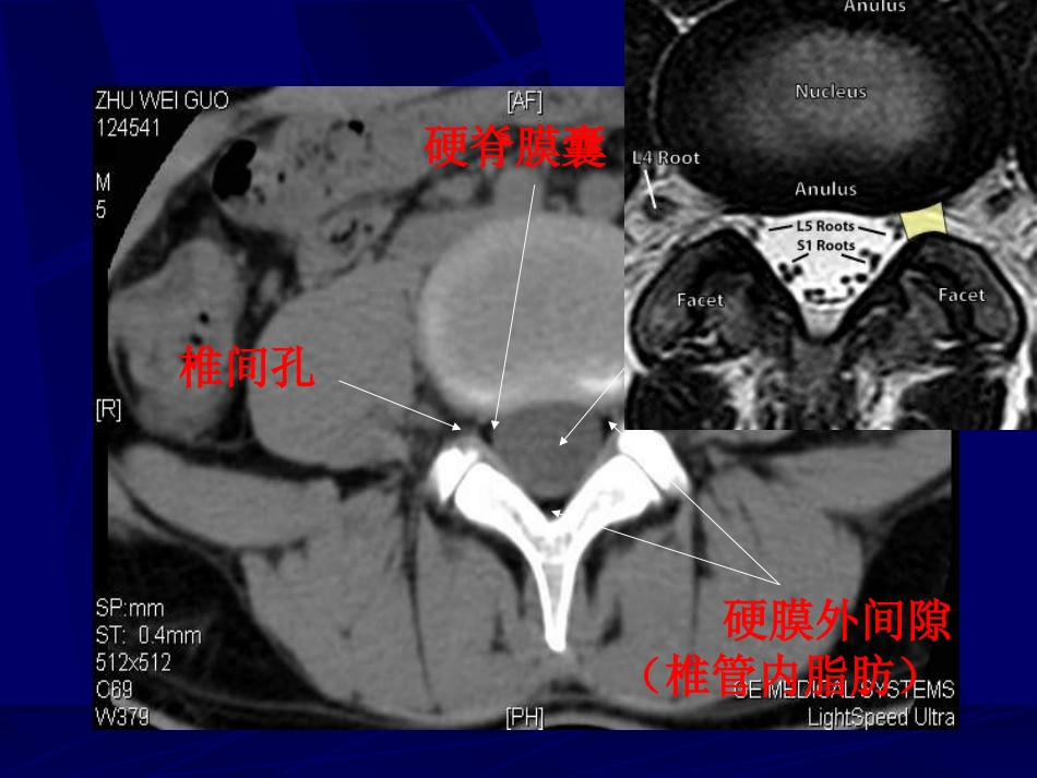 外影像与诊断学：腰椎影像解剖及常见病变_第10页