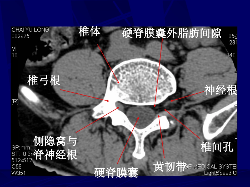 外影像与诊断学：腰椎影像解剖及常见病变_第14页