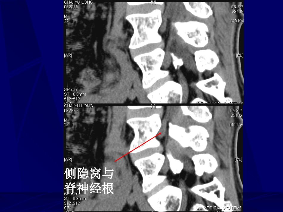 外影像与诊断学：腰椎影像解剖及常见病变_第15页