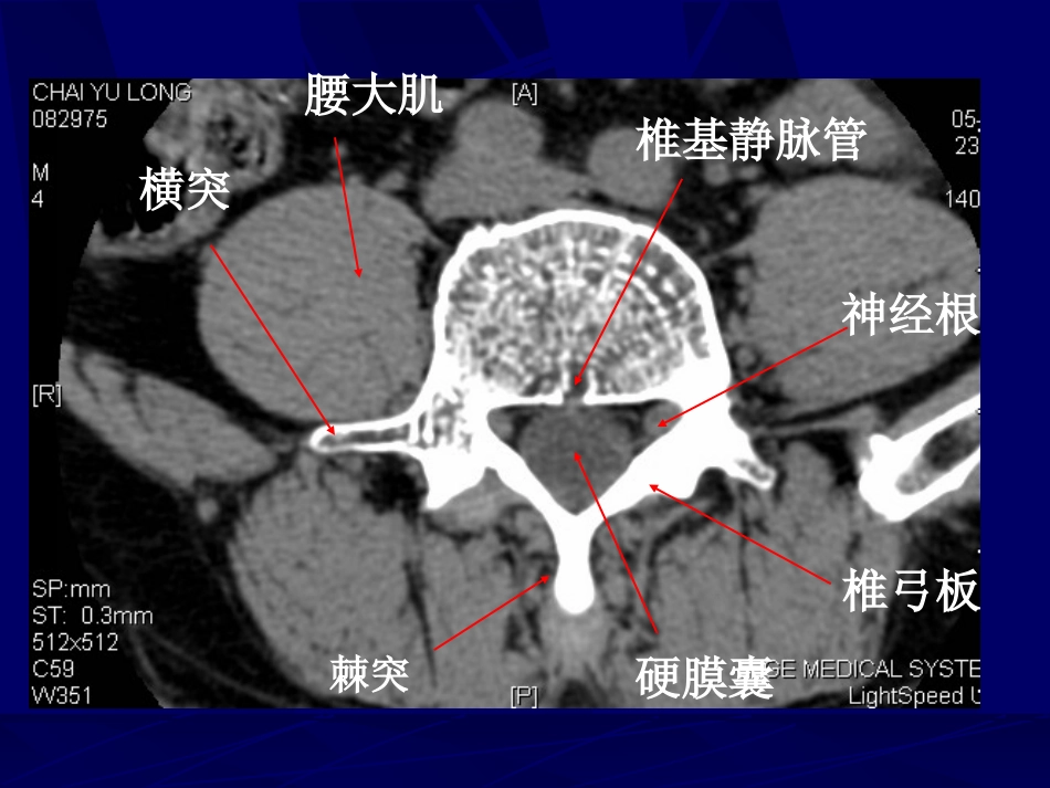 外影像与诊断学：腰椎影像解剖及常见病变_第9页