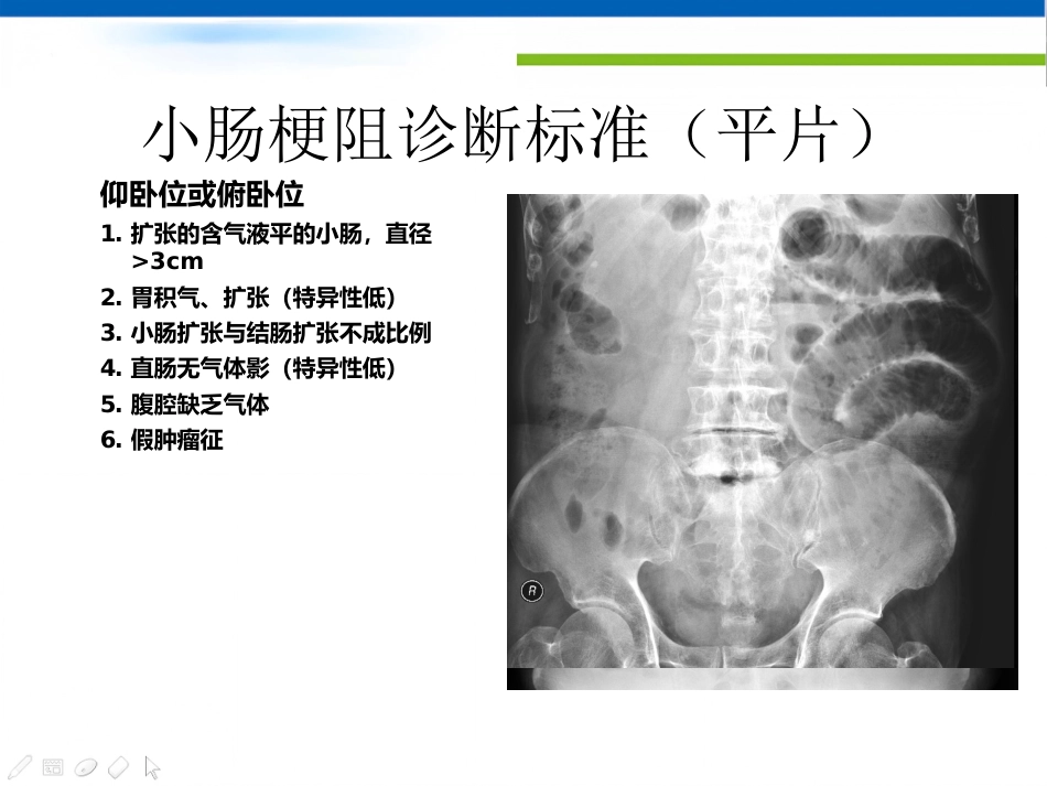 肠梗阻的影像诊断肠梗阻的影像分析_第10页
